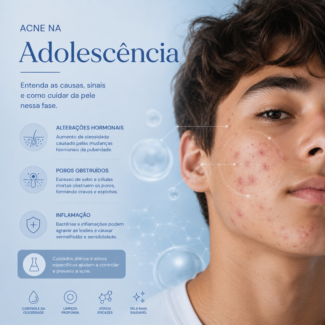 Acne na adolescência e cuidados com a pele