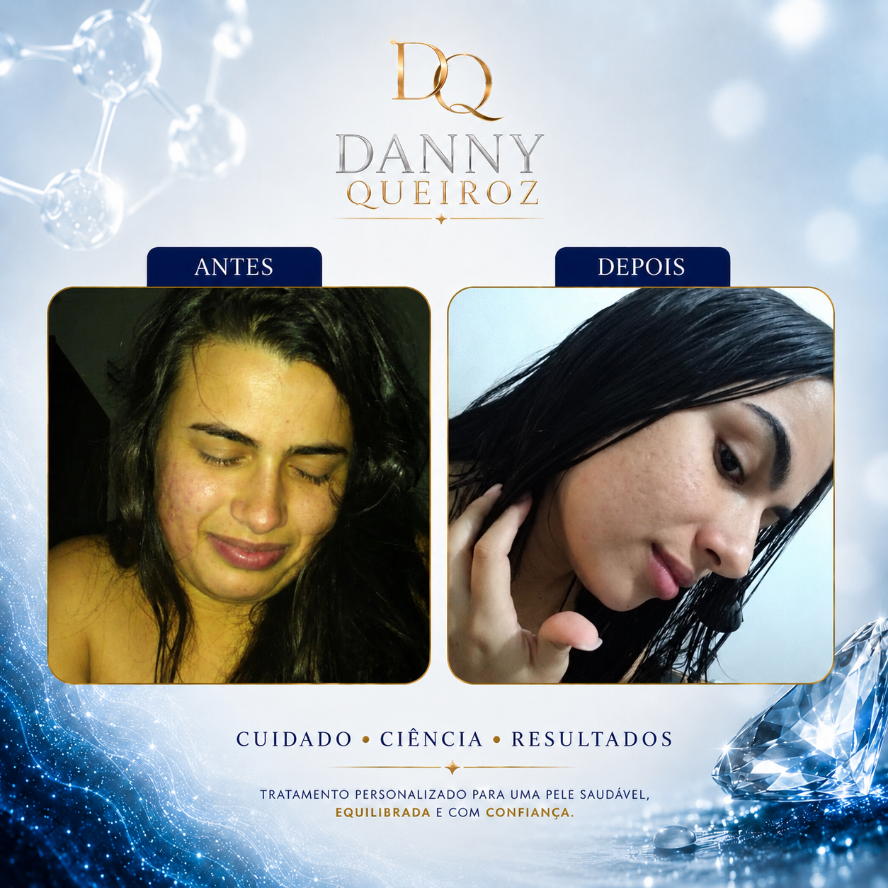 Resultado tratamento acne adulta