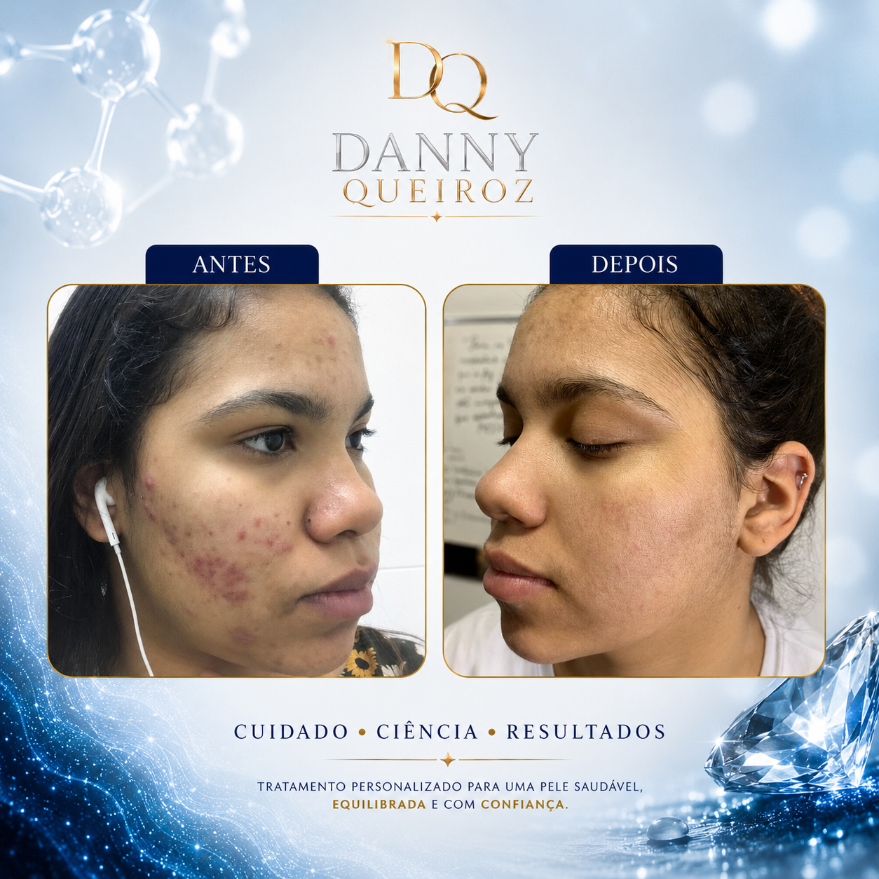 Resultado tratamento acne adolescente