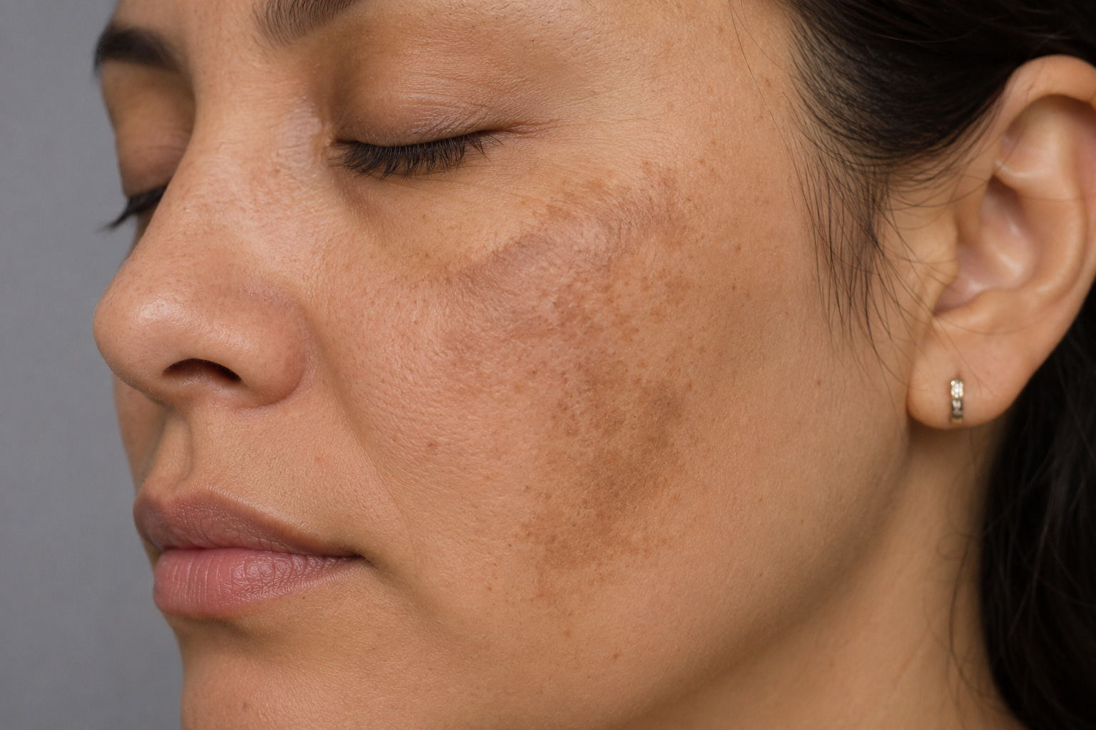 Melasma hormonal