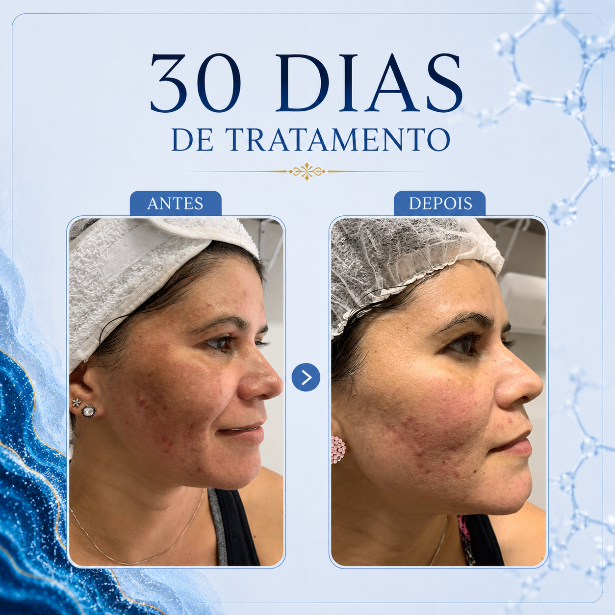 Resultado clareamento de manchas faciais