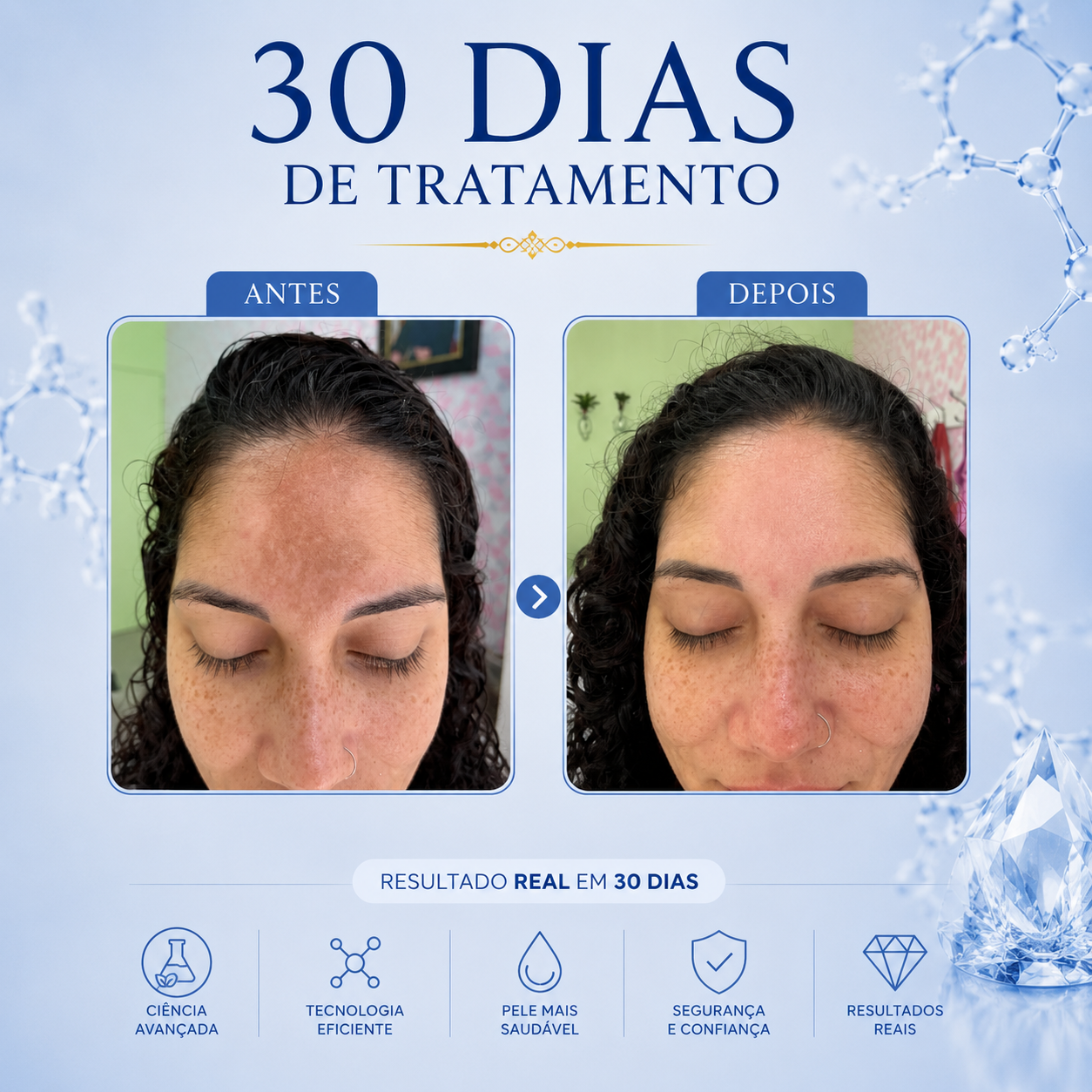 Resultado tratamento de melasma em Copacabana