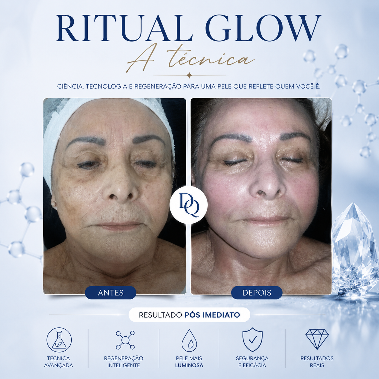 Resultado de rejuvenescimento facial para melhora da firmeza da pele em Araruama